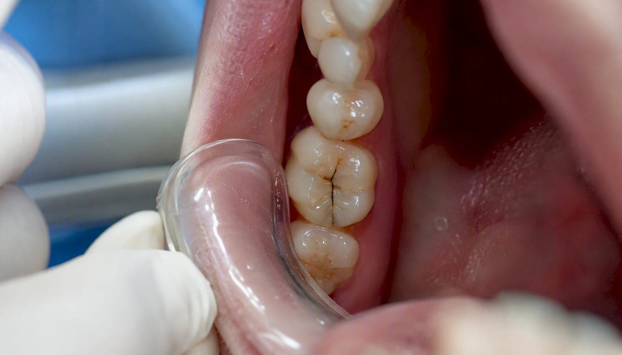 Cracked Tooth Repair: What to Do Now and How Dentists Fix It