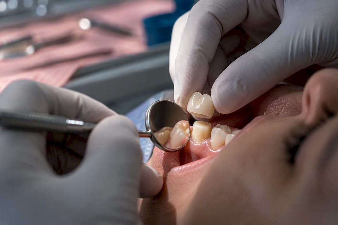 Most Crown Sensitivity Ends in 72 Hours — Starboard Dental: Patient Advice