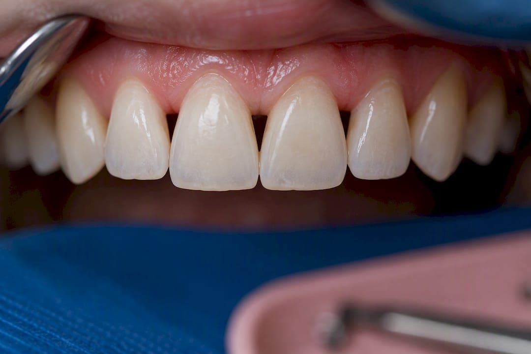 Black Triangles Between Teeth: When the 5 mm Rule Decides Treatment