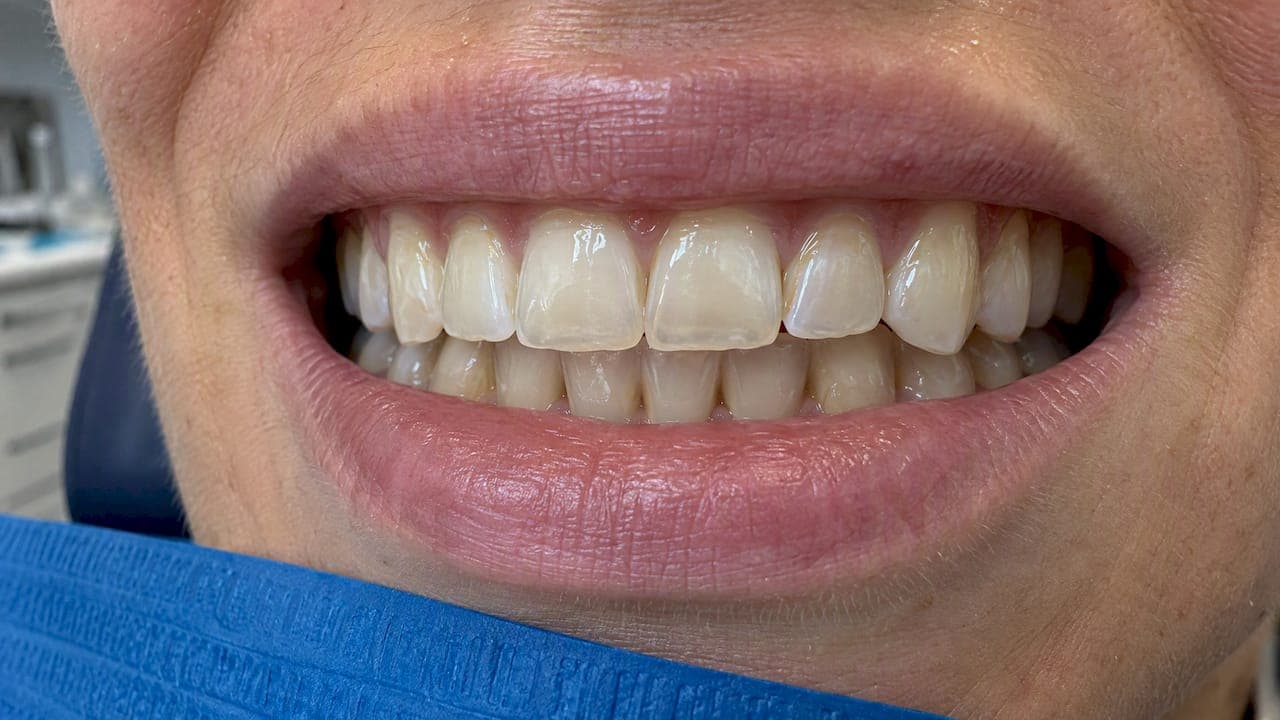 Enamel Erosion: Causes, Signs and What Can Be Done