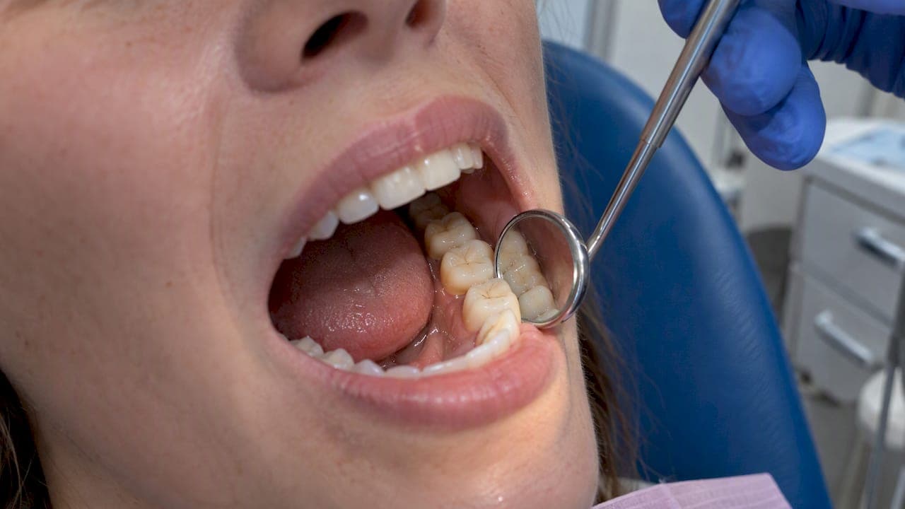 Composite Fillings Lifespan: How Long White Fillings Last